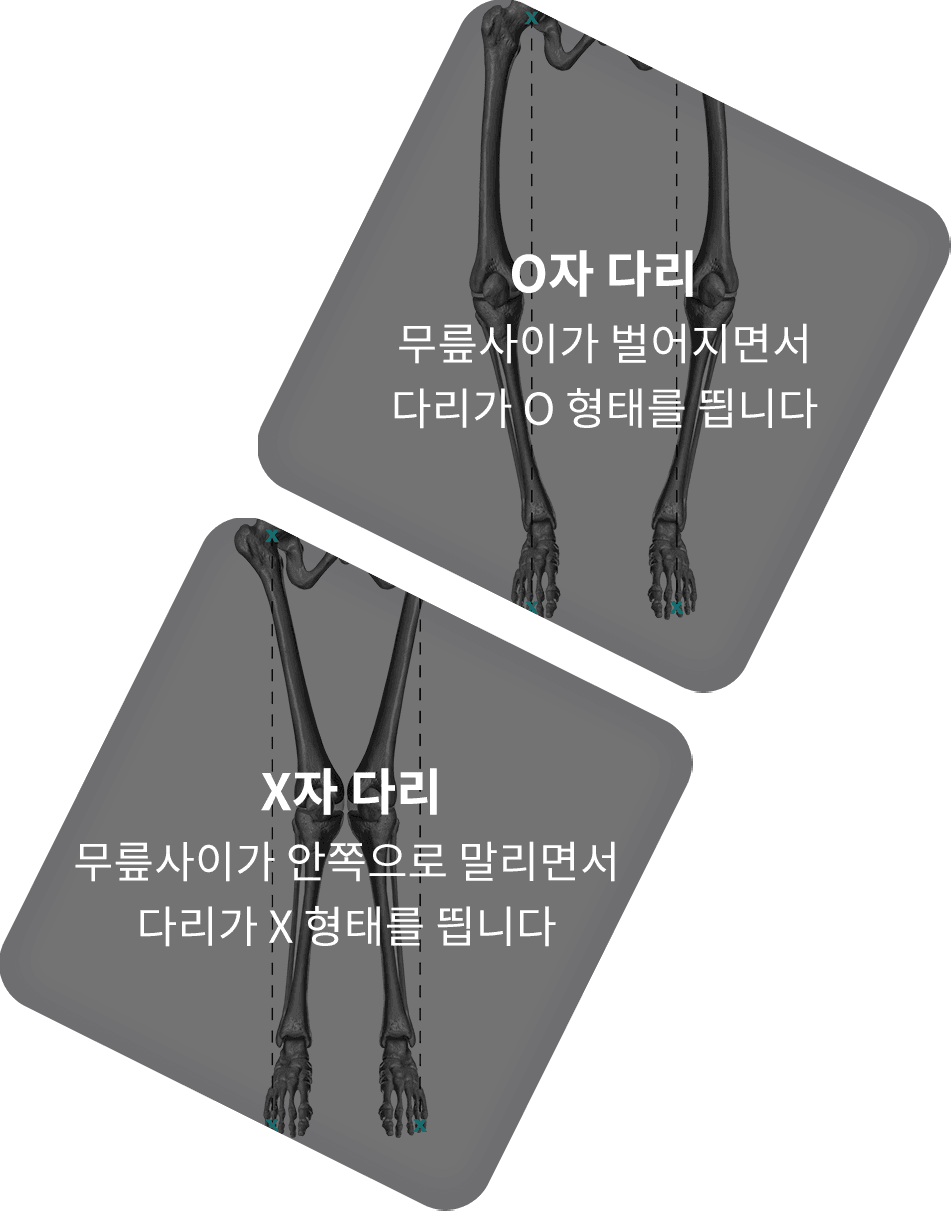 무릎 사이가 벌어지는 O자 다리와 무릎 사이가 안쪽으로 말리는 X자 다리를 비교한 도해