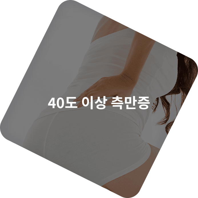 40도 이상 측만증 사례를 보여주는 이미지